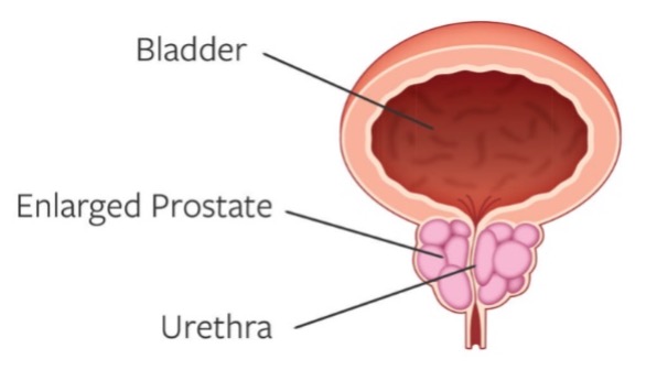 Enlarged Prostate Enlarged Prostate