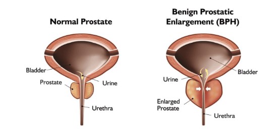 Normal Prostate v. Benign Prostatic Enlargement (BPH) Normal Prostate v. Benign Prostatic Enlargement (BPH)